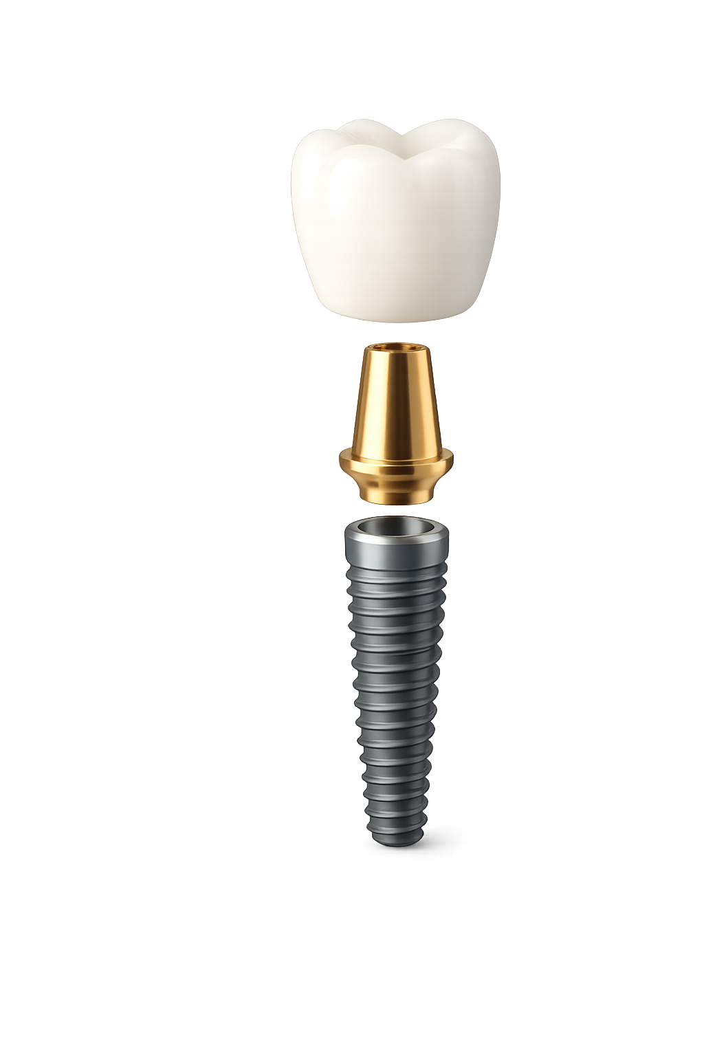 Implante, pilar y corona — ImplantB